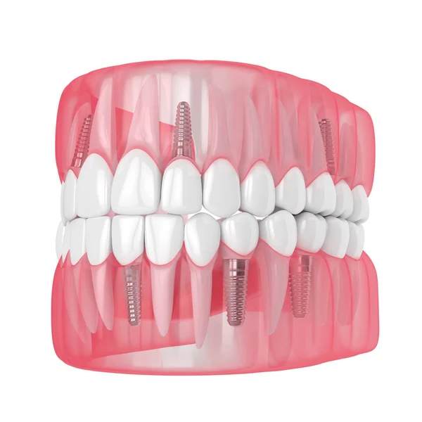 3D-s állkapocs Fogbeültetés fogászati implantátumokkal — Stock Fotó