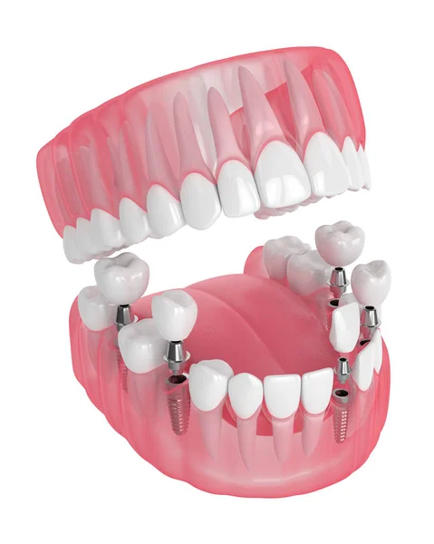 3D render van kaak met tandheelkundige implantaten — Stockfoto