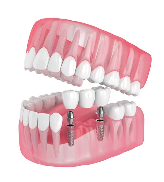 3d render of jaw with implants supported dental bridge — Stock Photo, Image