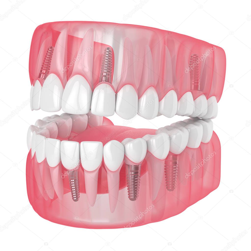 3d render of jaw with dental implants