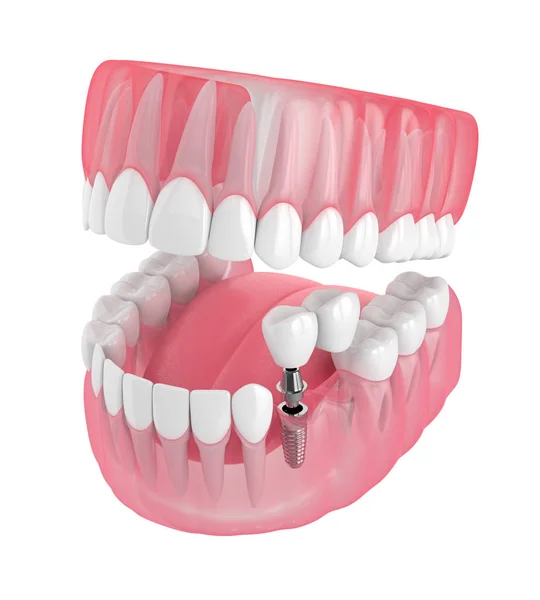 3d renderizado de mandíbula con soporte de implante puente voladizo dental —  Fotos de Stock