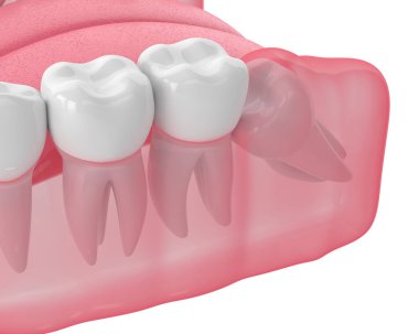 3d render of jaw with wisdom mesial impaction clipart