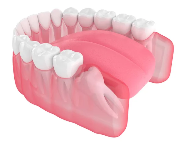 3d rendición de la mandíbula con la impactación mesial sabiduría —  Fotos de Stock