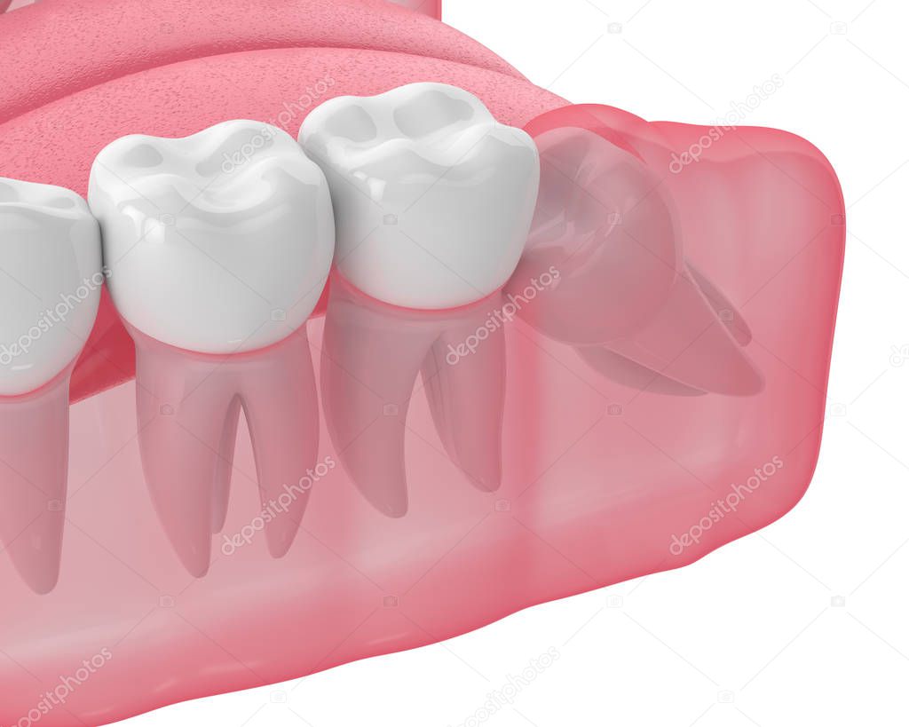 3d render of jaw with wisdom mesial impaction