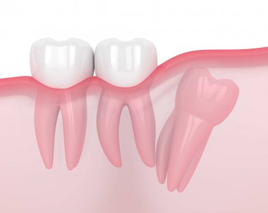 Bilgelik distal impaction ile çene 3d render