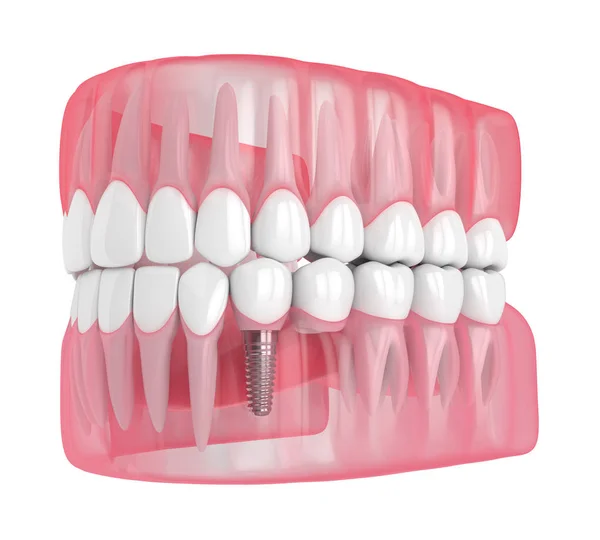 3D rendering av käken med implantat som stöds Dental grenställ bro — Stockfoto