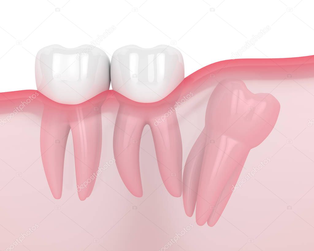 3d render of jaw with wisdom distal impaction