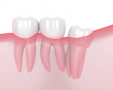 Bilgelik distal impaction ile çene 3d render