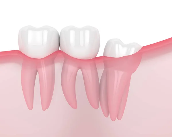 3D teszi az állkapocs a bölcsesség distalis impakt — Stock Fotó