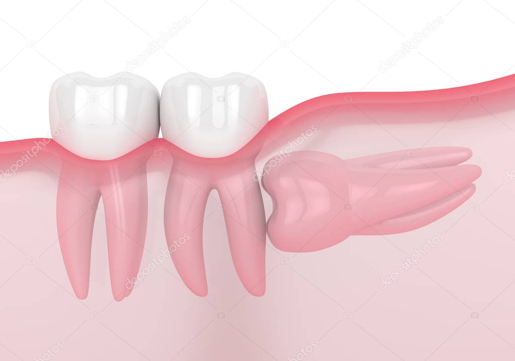 3d render of jaw with wisdom horizontal impaction