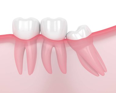 Bilgelik mesial impaction ile çene 3d render