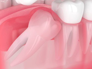 Bilgelik mesial impaction ile çene 3d render