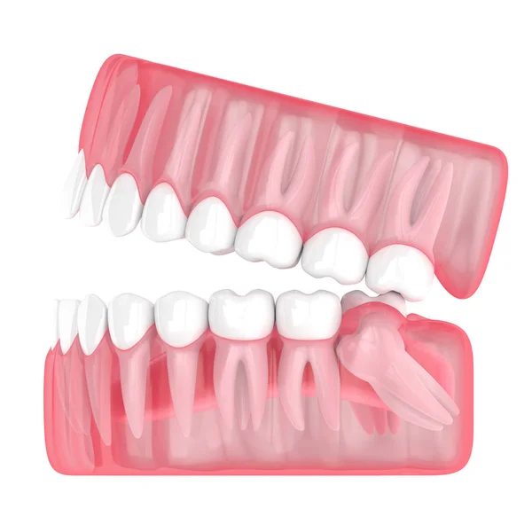 3d render of jaw with wisdom mesial impaction — Stock Photo, Image
