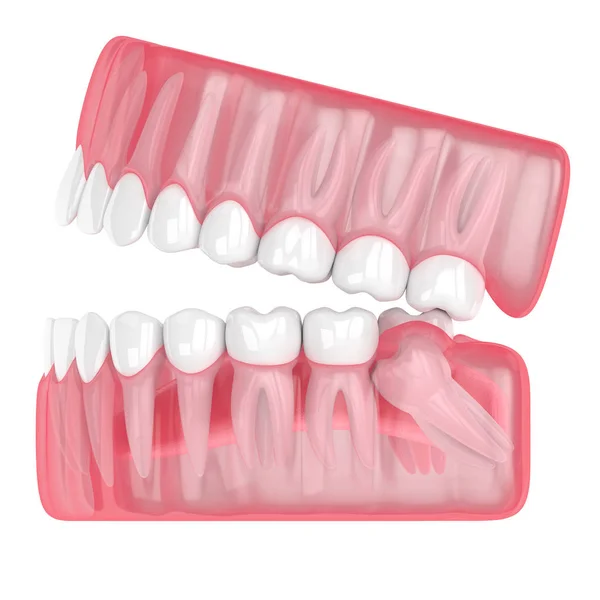 Bilgelik mesial impaction ile çene 3d render — Stok fotoğraf