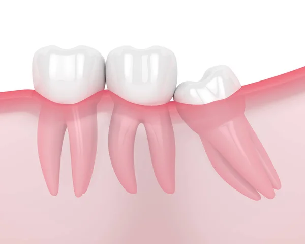 3d render of jaw with wisdom mesial impaction — Stock Photo, Image