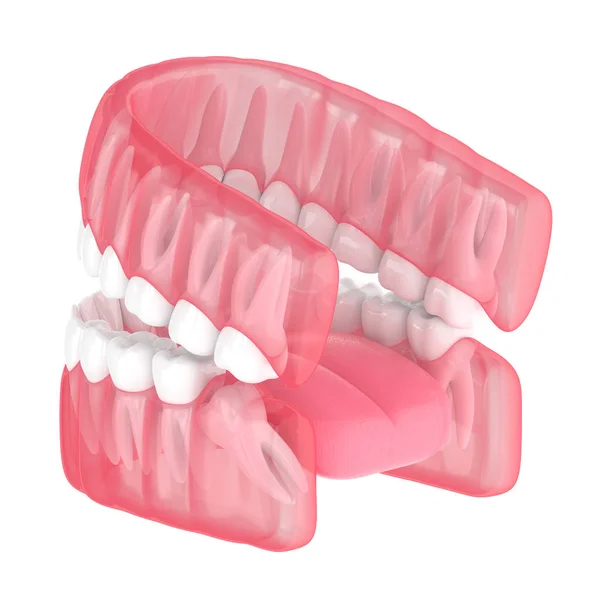 3d rendición de la mandíbula con la impactación mesial sabiduría —  Fotos de Stock