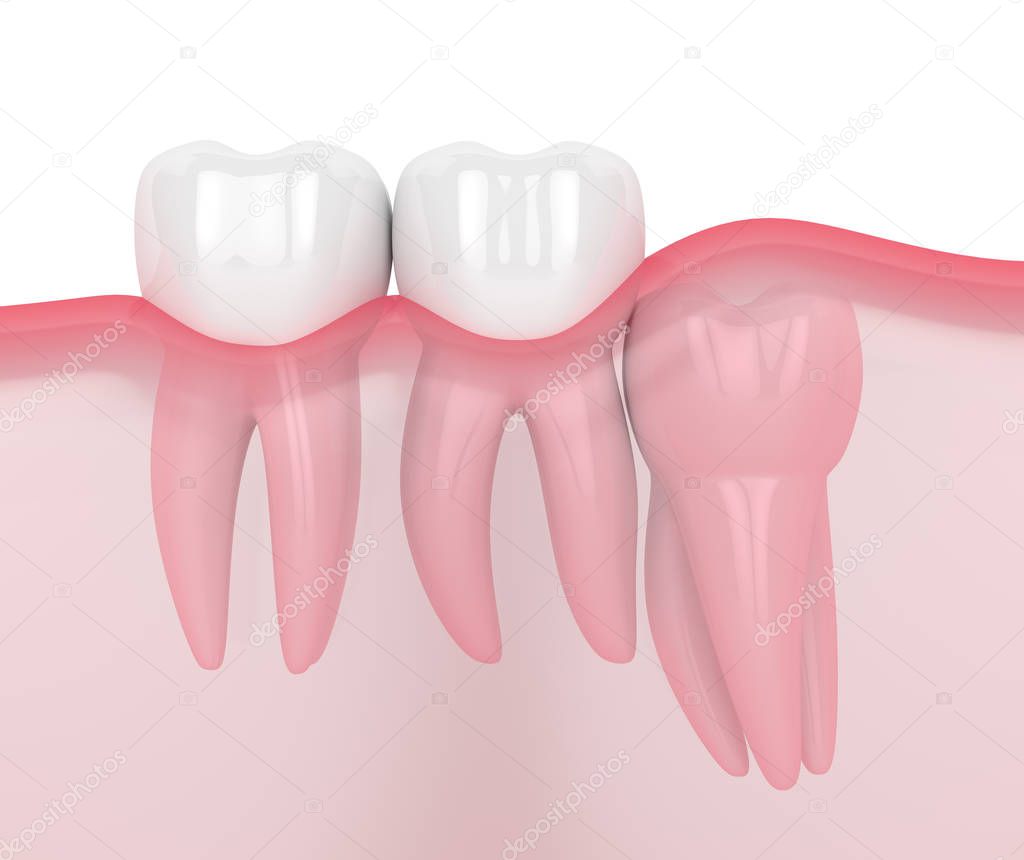 3d render of jaw with wisdom vertical impaction
