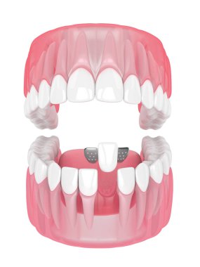 çene dişleri ve maryland ile 3D render köprü