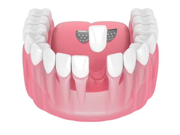 3D render av käke med tänder och maryland överbrygga — Stockfoto