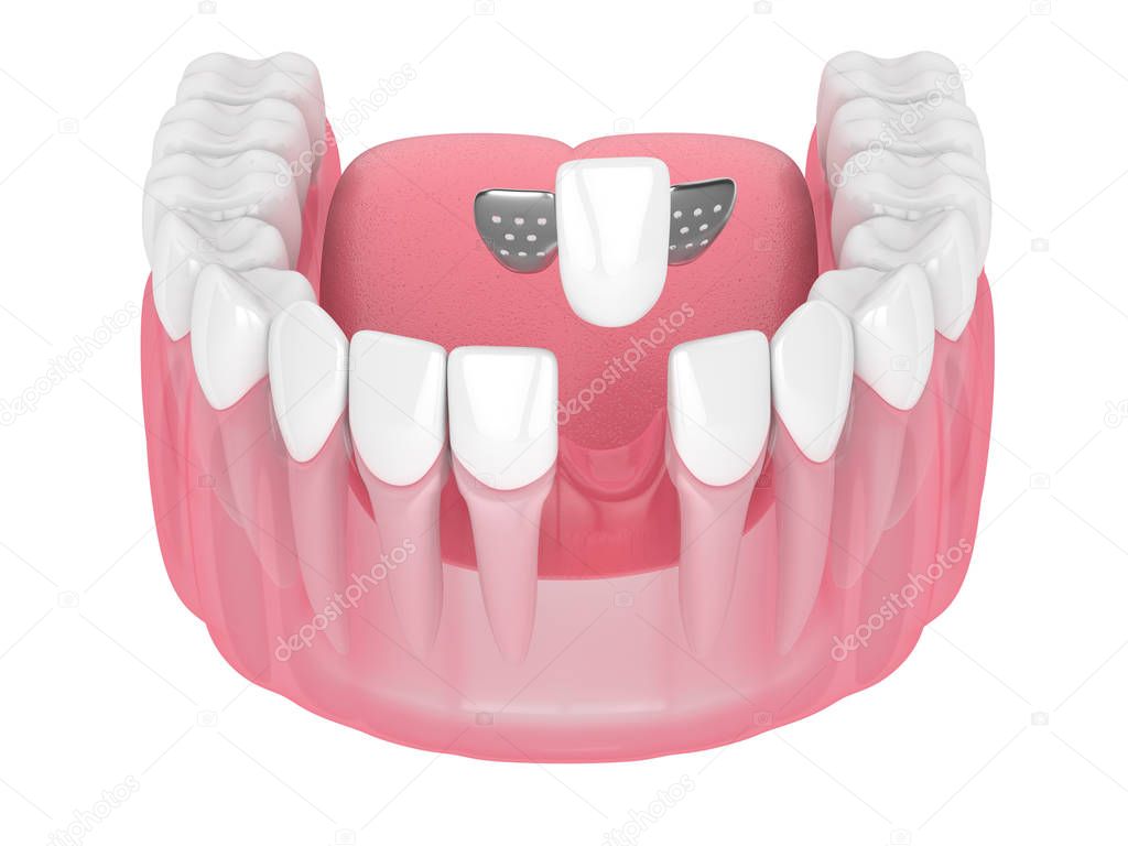 3d render of jaw with teeth and maryland bridge