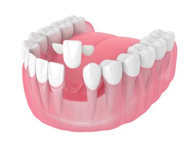 çene dişleri ve maryland ile 3D render köprü