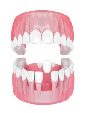 çene dişleri ve maryland ile 3D render köprü