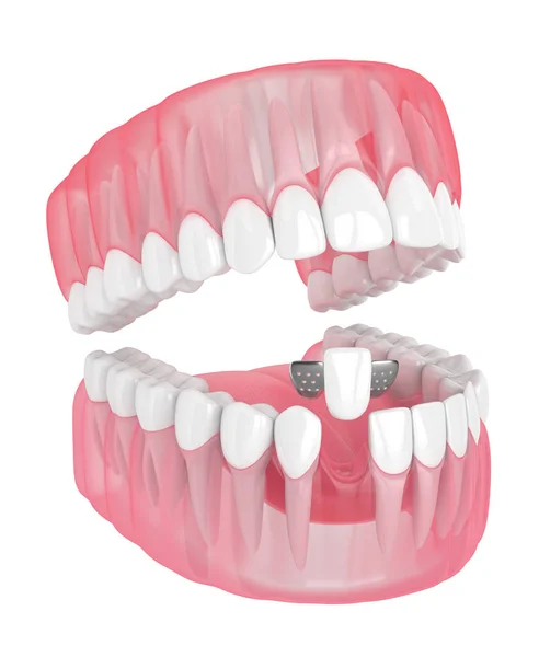 3d renderização de mandíbula com dentes e ponte maryland — Fotografia de Stock