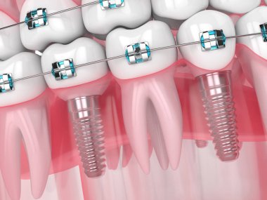 İmplantlar ve ortodontik parantezile çenenin 3boyutlu işlenmesi