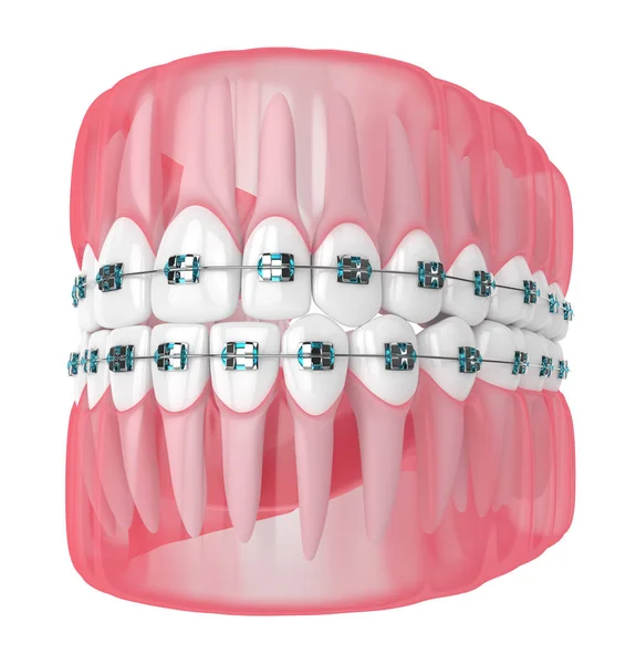 3D render van kaak met tanden en orthodontische beugel — Stockfoto