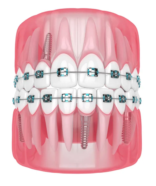 3D renderowanie szczęk z implantami i ortodontyczne szelki — Zdjęcie stockowe