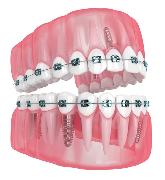 3d renderização da mandíbula com implantes e aparelho ortodôntico — Fotografia de Stock