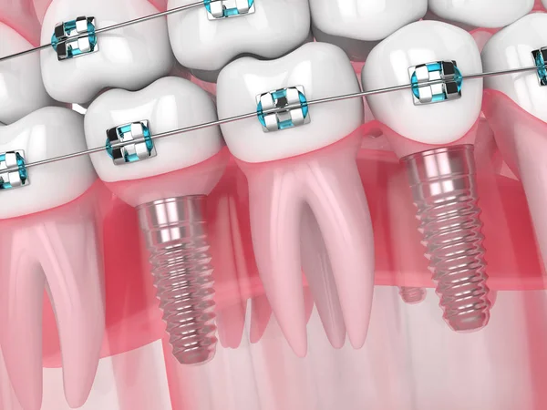 3d render of jaw with implants and orthodontic braces — Stock Photo, Image