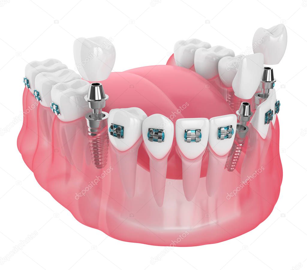 3d render of jaw with implants and orthodontic braces