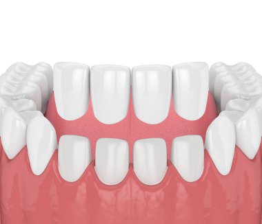 Kaplamalı dişlerin 3boyutlu işlemesi