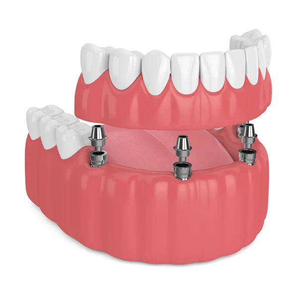 インプラント部分入れ歯の3Dレンダリング — ストック写真