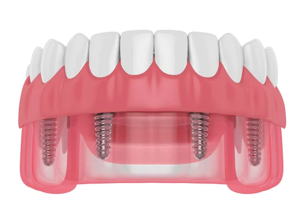3D візуалізація часткового зубного ряду імплантатів — стокове фото