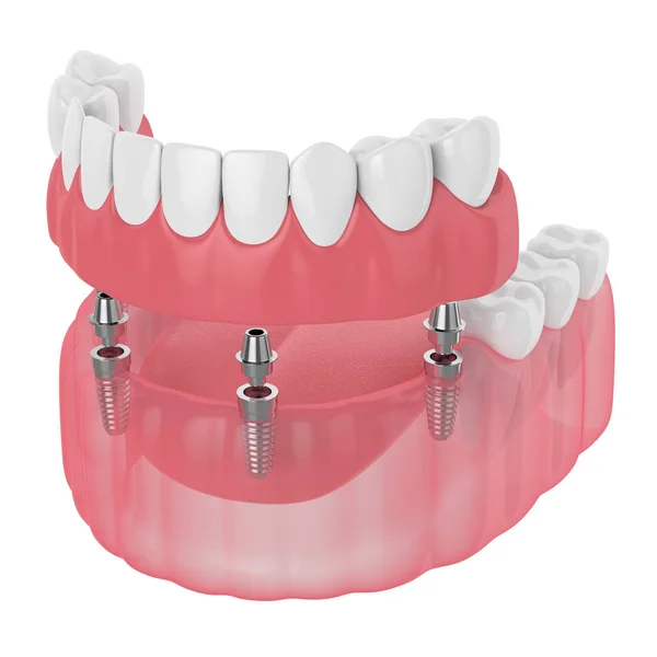 3d render of implant partial denture — Stock Photo, Image