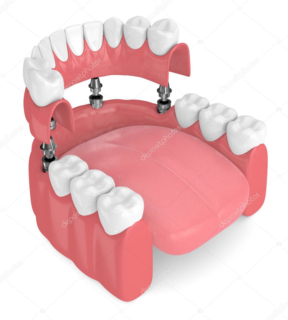 3d render of implant partial denture