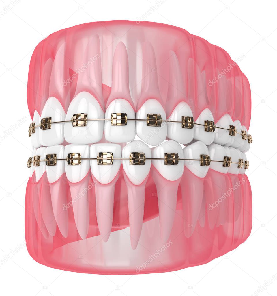 3d render of jaw with teeth and orthodontic braces