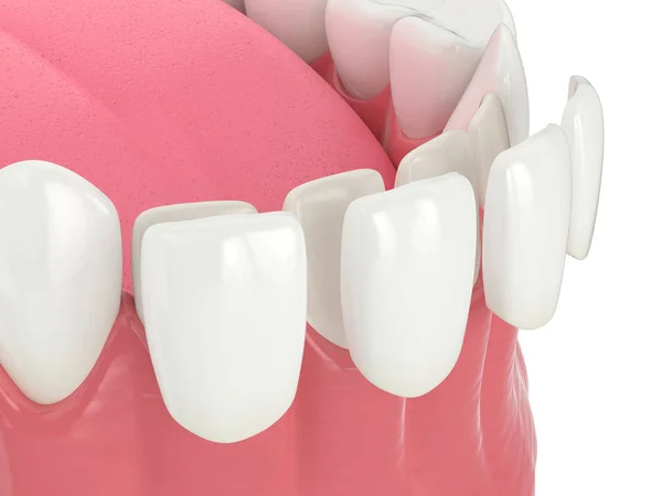 Kaplamalar ile alt çene 3d render