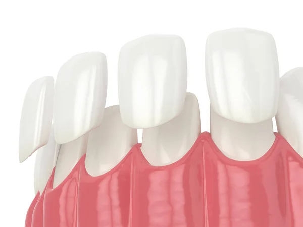 3d renderizado de dientes con chapas — Foto de Stock