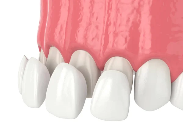 3d render of upper jaw with four veneers — Stock Photo, Image