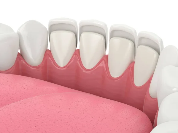 3d renderizado de dientes con chapas — Foto de Stock