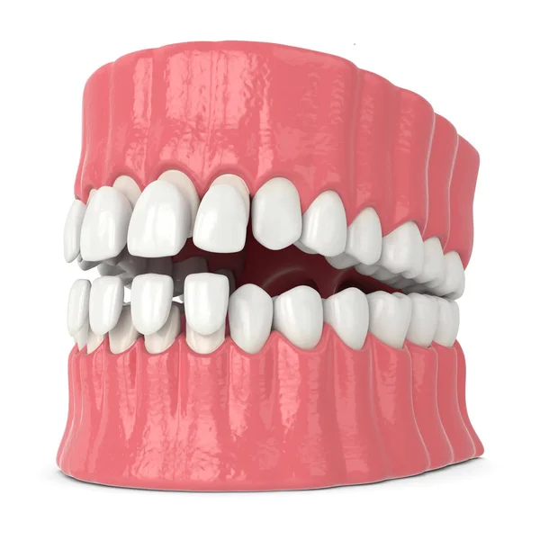 3d render of jaw with upper and lower veneers — Stock Photo, Image