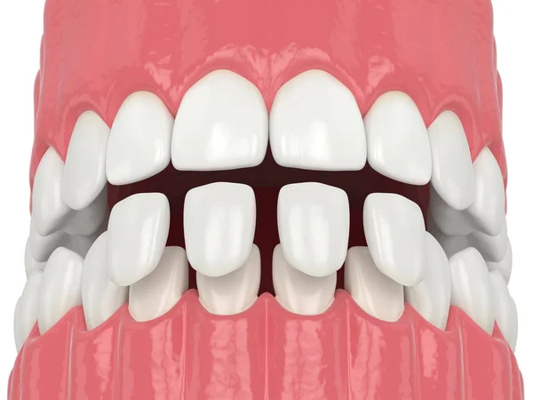 3d render of jaw with lower veneers — Stock Photo, Image