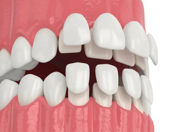 3d render of jaw with upper and lower veneers — Stock Photo, Image