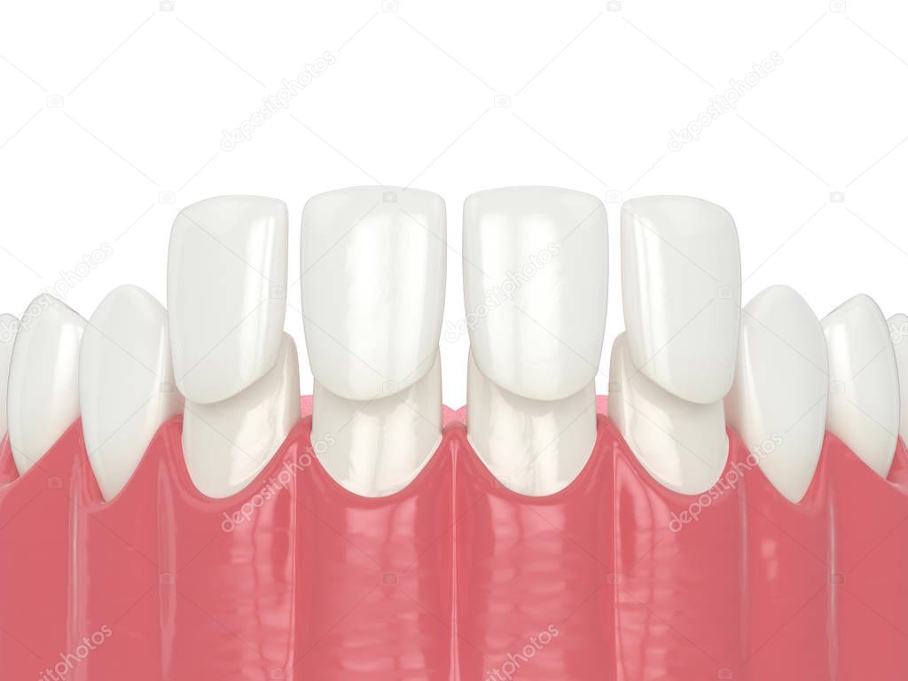 3d render of lower jaw with veneers