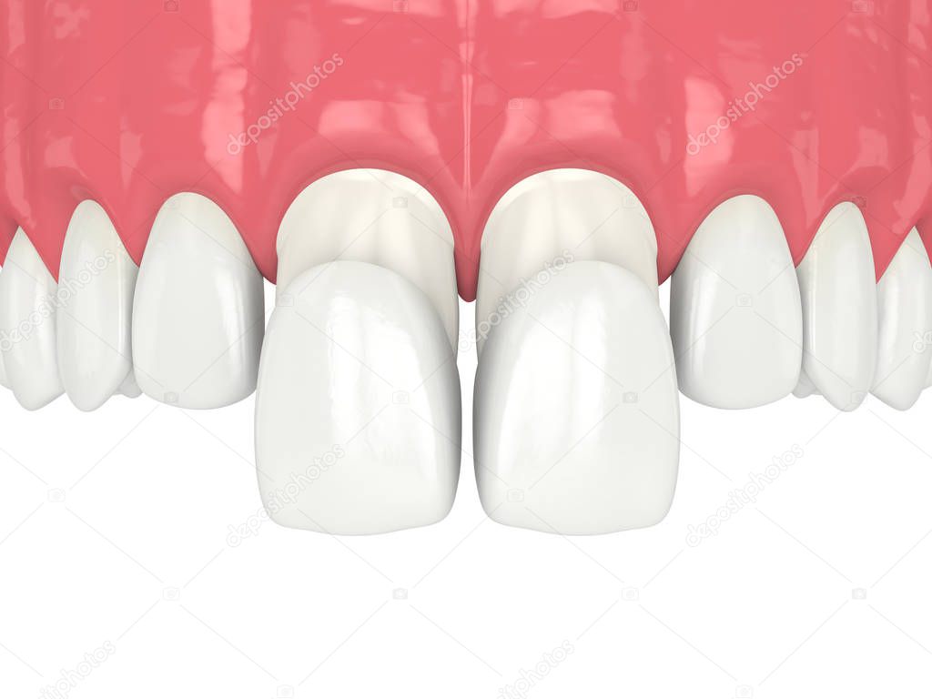 3d render of upper jaw with veneers