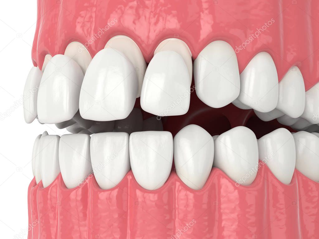 3d render of jaw with teethand upper veneers