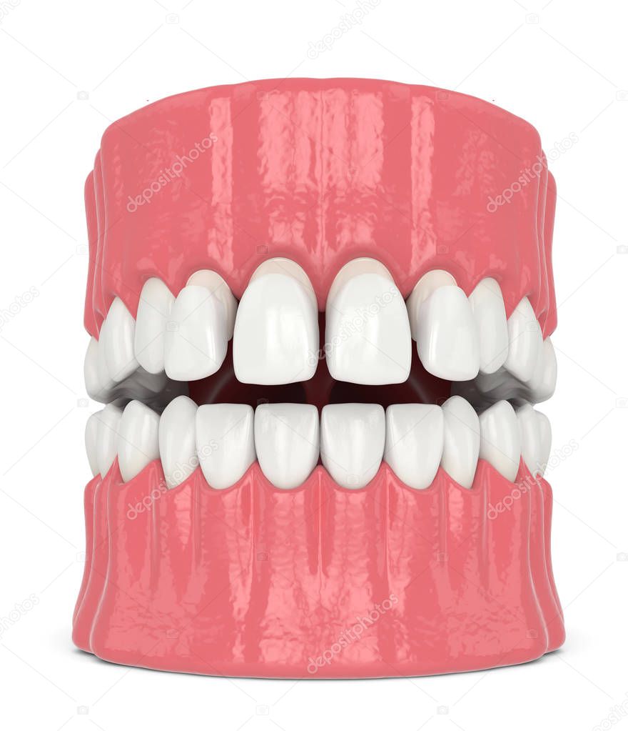 3d render of jaw with upper veneers
